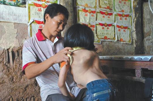 有嚴(yán)重脊椎畸形及胸腔隆突病的李文霞。