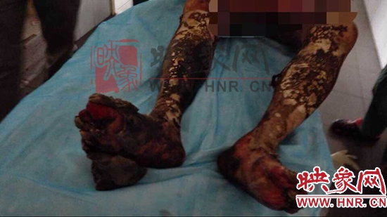 張鐵虎下肢嚴(yán)重?zé)齻? alt=