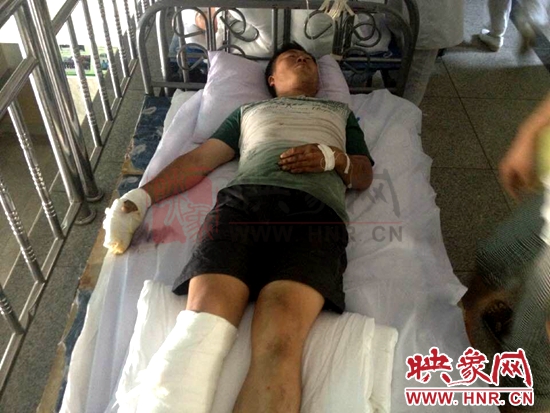 張國建右手及腿部多處燒傷 張國建右手及腿部多處燒傷