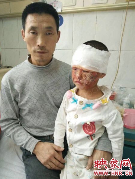 6歲女童被火燒傷 6歲女童被火燒傷