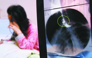 假牙上的鋼絲刺破食管，而薄薄的食道壁緊貼主動脈血管，極易造成血管破裂