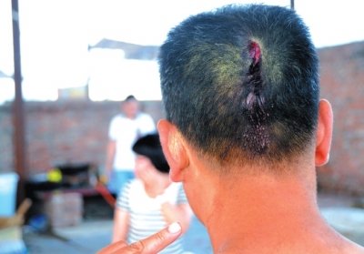 崔先生頭部受傷。京華時報記者趙思衡攝/視頻