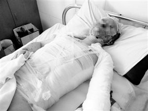 周小姐的頭、頸、軀干、四肢均被燒傷，其中面部燒傷最為嚴(yán)重。