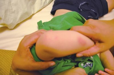 孩子身上有多處明顯傷痕。京華時報讀者供圖