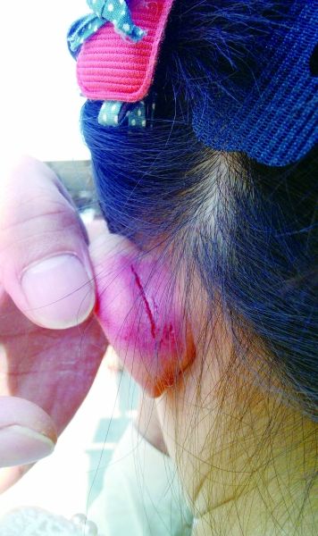 　　女童的耳朵被老師揪裂。圖片由女童家人提供