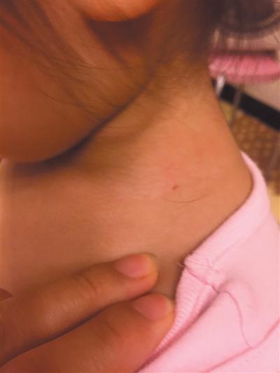 北京兩幼兒身現(xiàn)傷口稱遭老師針扎 幼兒園否認 北京兩幼兒身現(xiàn)傷口稱遭老師針扎 幼兒園否認