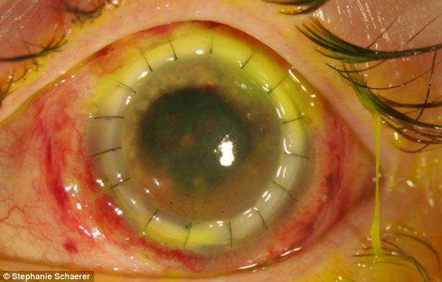 恐怖慎入！隱形眼鏡致英女子摘除眼球