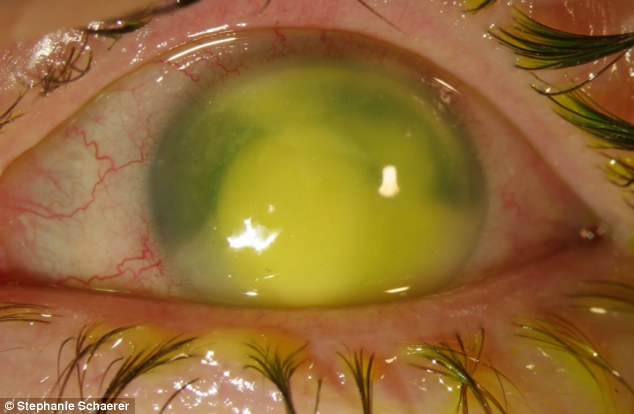 恐怖慎入！隱形眼鏡致英女子摘除眼球