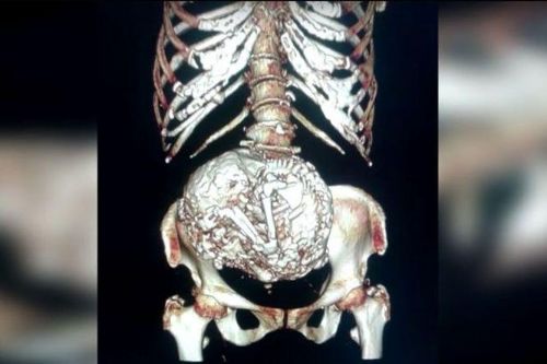 鈣化胎兒留在子宮超過(guò)半世紀(jì) 鈣化胎兒留在子宮超過(guò)半世紀(jì)