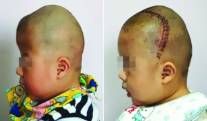 術(shù)前(左),術(shù)后(右)