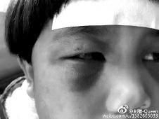 6月2日，網(wǎng)曝渭南市臨渭區(qū)一不滿5歲的女童遭奶奶毆打，眼圈青腫，引起網(wǎng)友關(guān)注，但孩子父母和爺爺均稱是摔倒導致。相關(guān)部門介入調(diào)查發(fā)現(xiàn)確為奶奶毆打所致，鑒于其身體原因已進行批評教育。