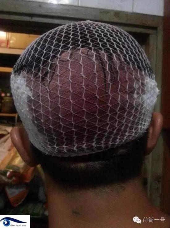 李律師受傷后縫合三針。