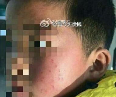 小學(xué)校長(zhǎng)筆扎學(xué)生左臉17個(gè)眼 激怒網(wǎng)友:教育界禽獸滾粗