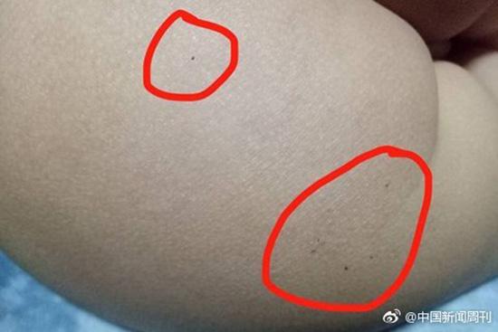 據(jù)多名紅黃藍(新天地分園)家長反映，孩子腿部、屁股、腋下出現(xiàn)針眼。