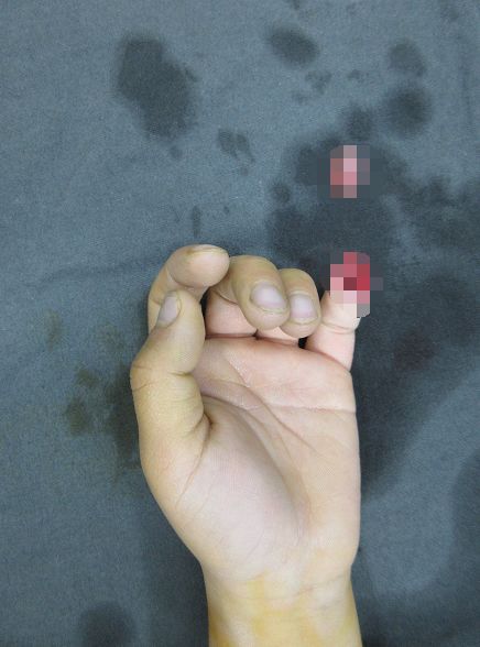 嚇哭！6歲男孩被夾斷手指 罪魁禍?zhǔn)拙故切７? oldsrc=