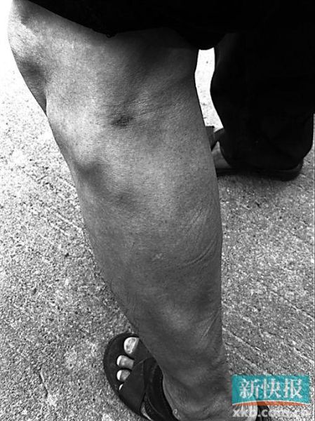 傷者身上遺留的彈痕。