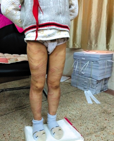 4月3日晚，微博網(wǎng)友“@朝廷半日閑”發(fā)圖文微博展示男童被虐待的慘狀。 微博截圖