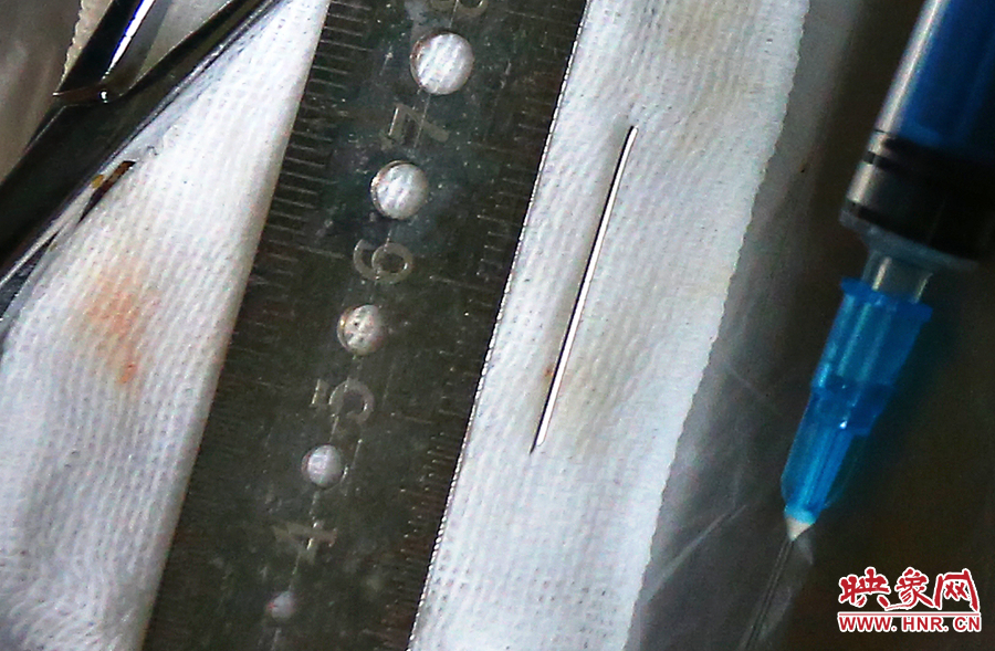 上午11點42分，大龍顱內的鋼針被取出