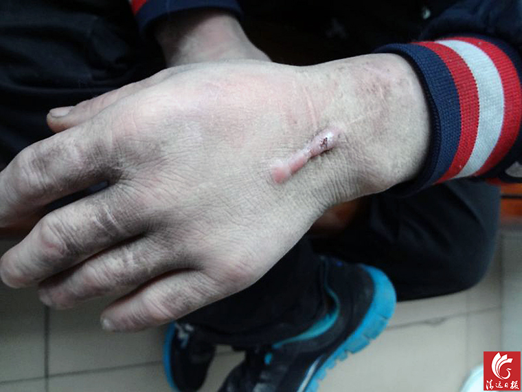 被發(fā)現(xiàn)男子手上的傷疤。