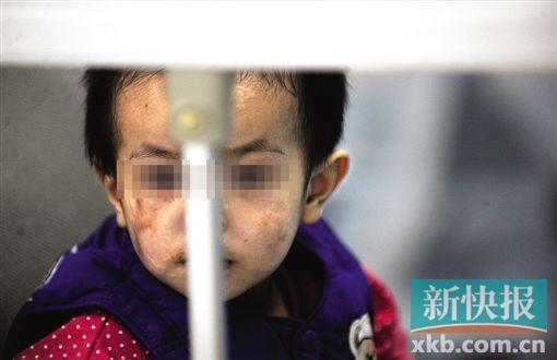 去年3月就能出院的小華(化名),目前還在廣州市婦兒醫(yī)療中心的PICU里住著。新快報記者 孫毅/攝