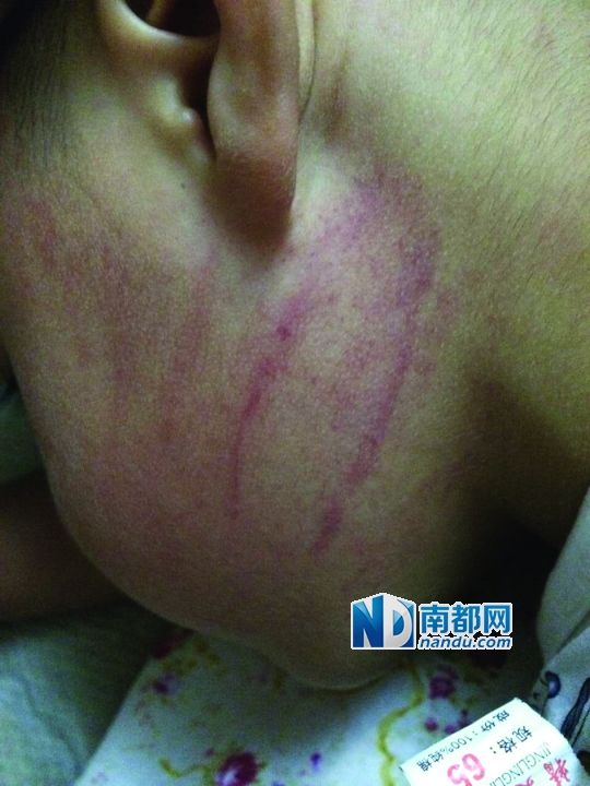 小逸臉上淤痕清晰可見(jiàn)。