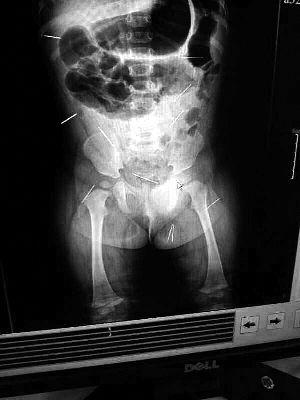 目前體內(nèi)的12根鋼針多分布在孩子的臀部，一根在腹部，其余3根在胸腔附近，其中一根很接近心臟